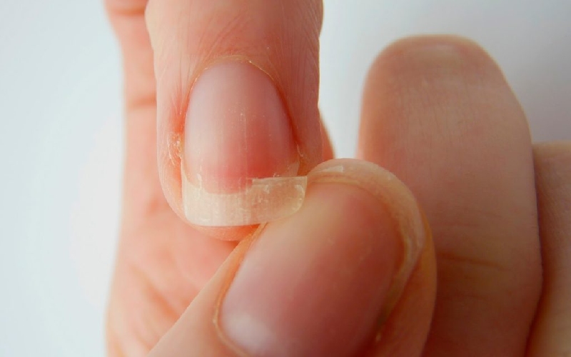 Nguyên nhân vì sao móng tay thường xuyên bị gãy?
